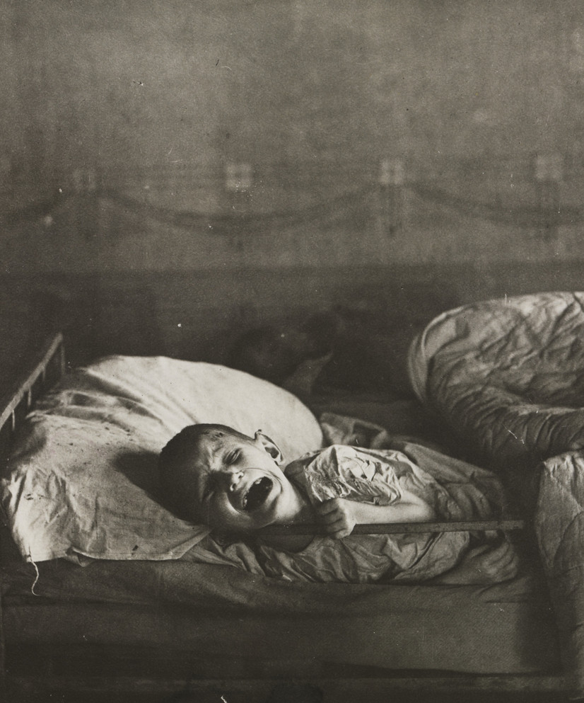 Fra et sykehus for sultende barn i Buguruslan i Orenburg oblast i Russland under hungersnøden
i 1921. En gutt gråter av smerter på grunn av skjørbuk.