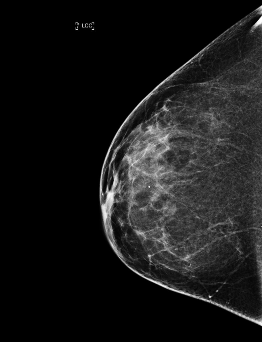 Mammografi. Foto: National Cancer Institute, National Institutes of Health